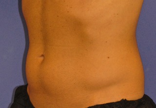 Patient 4 before photo of Coolsculpting patient at Sensational Skin Scottsdale
