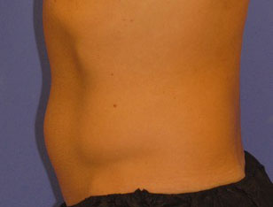 Patient 4 before photo of Coolsculpting patient at Sensational Skin Scottsdale