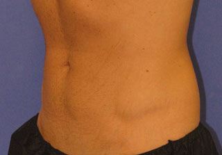 Patient 4 after photo of Coolsculpting patient at Sensational Skin Scottsdale
