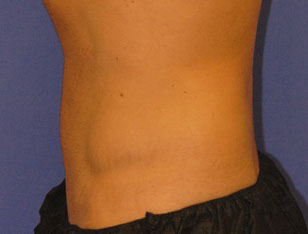 Patient 4 after photo of Coolsculpting patient at Sensational Skin Scottsdale