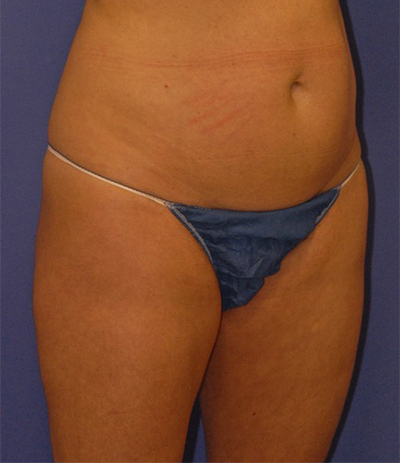 Patient 5 before photo of Coolsculpting patient at Sensational Skin Scottsdale