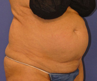 Patient 6 before photo of Coolsculpting patient at Sensational Skin Scottsdale