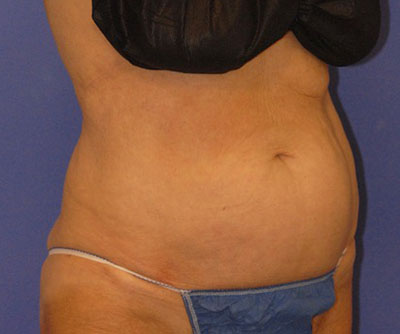 Patient 6 after photo of Coolsculpting patient at Sensational Skin Scottsdale