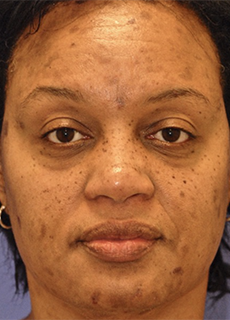 Before ZO Skin Health patient