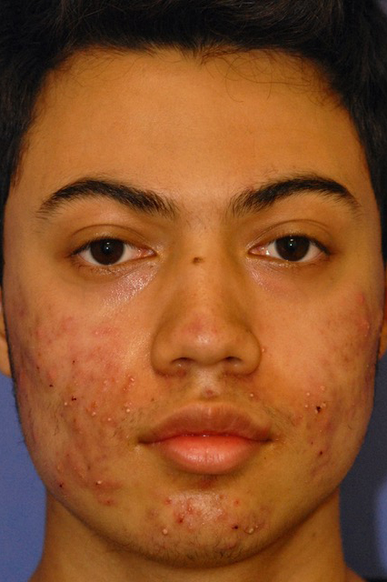 Patient 1 before photo of Acne & Acne Scar Laser Treatment patient at Sensational Skin Scottsdale