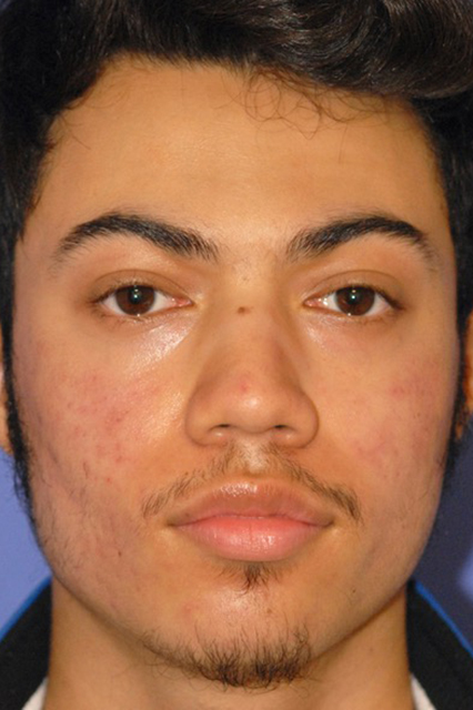 Patient 1 after photo of Acne & Acne Scar Laser Treatment patient at Sensational Skin Scottsdale
