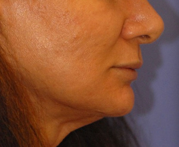 Patient 1 before photo of PDO Threadlift patient at Sensational Skin Scottsdale