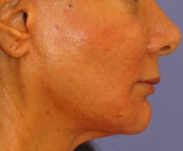 Patient 1 after photo of PDO Threadlift patient at Sensational Skin Scottsdale