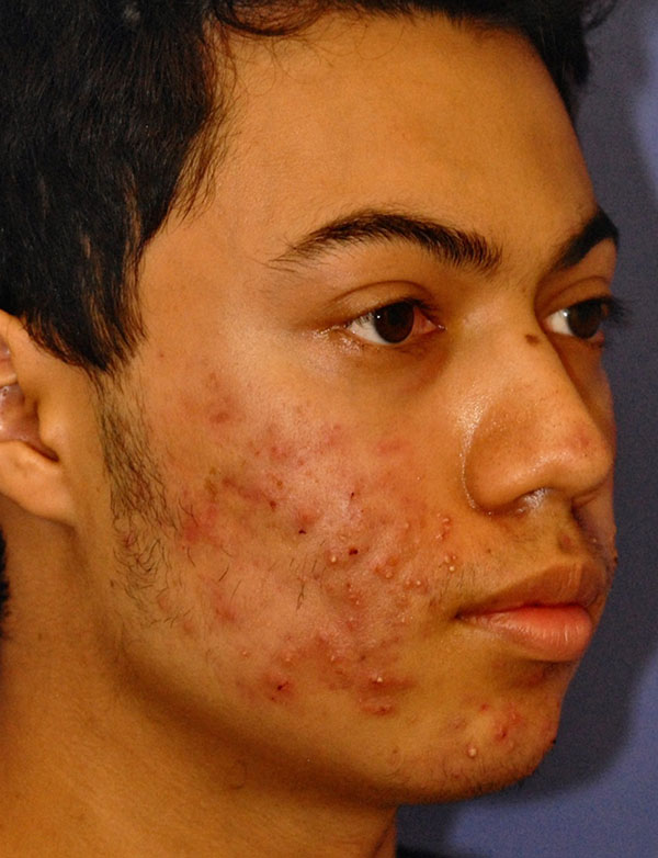 Patient 1 before photo of Acne & Acne Scar Laser Treatment patient at Sensational Skin Scottsdale