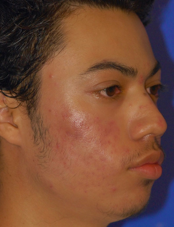 Patient 1 after photo of Acne & Acne Scar Laser Treatment patient at Sensational Skin Scottsdale