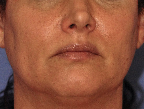 Before Sun Damage patient