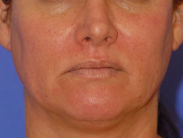 After Sun Damage patient