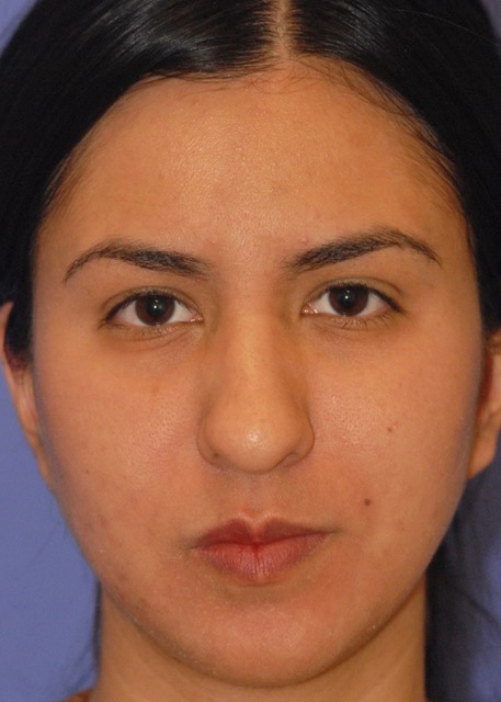 Patient 1 after photo of Acne Scars patient at Sensational Skin Scottsdale
