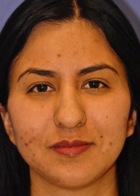 Patient 1 before photo of Acne Scars patient at Sensational Skin Scottsdale