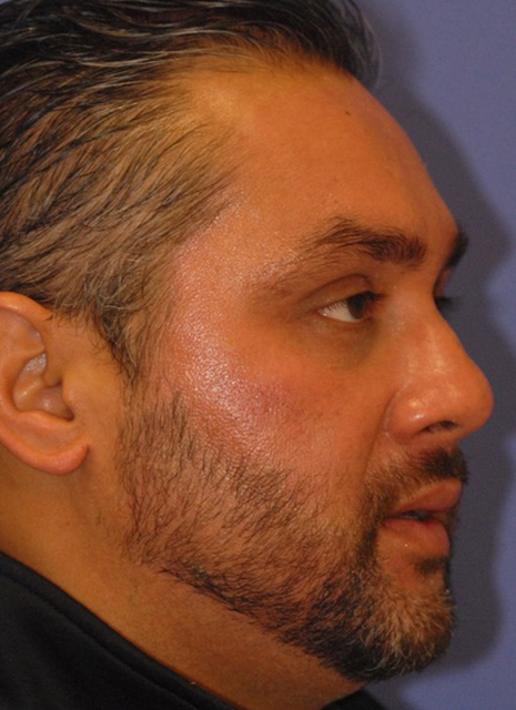 Patient 2 after photo of ZO Skin Health patient at Sensational Skin Scottsdale