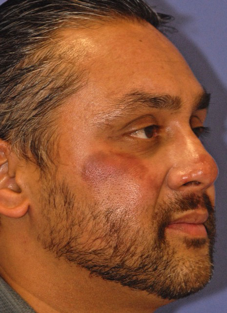 Patient 2 before photo of ZO Skin Health patient at Sensational Skin Scottsdale