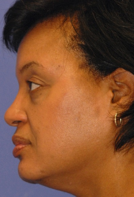 Patient 2 after photo of ZO Medical patient at Sensational Skin Scottsdale