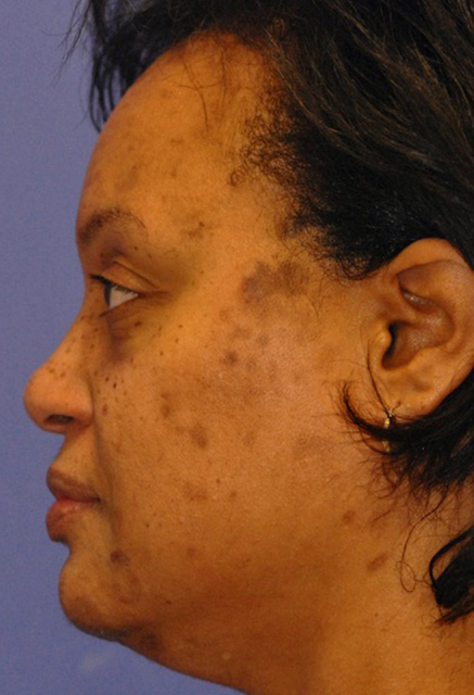 Patient 2 before photo of ZO Medical patient at Sensational Skin Scottsdale