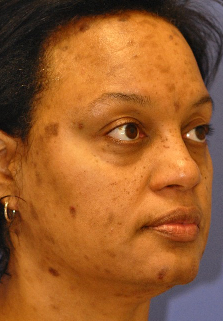 Patient 1 before photo of Melasma patient at Sensational Skin Scottsdale