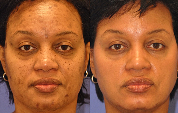 Hyperpigmentation Scottsdale