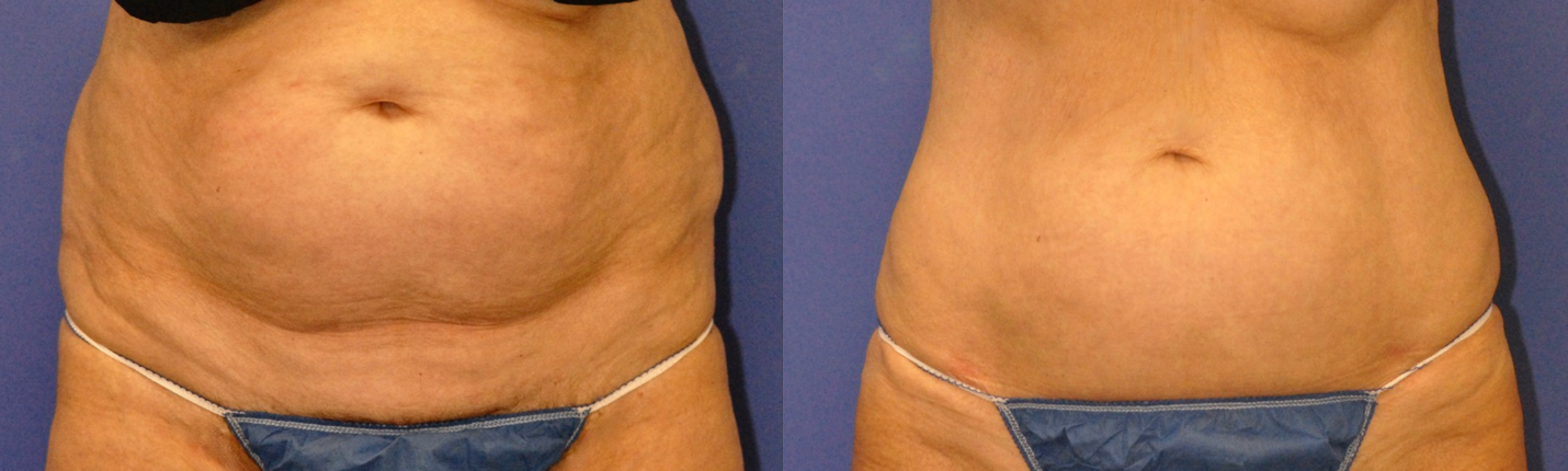 CoolSculpting Scottsdale