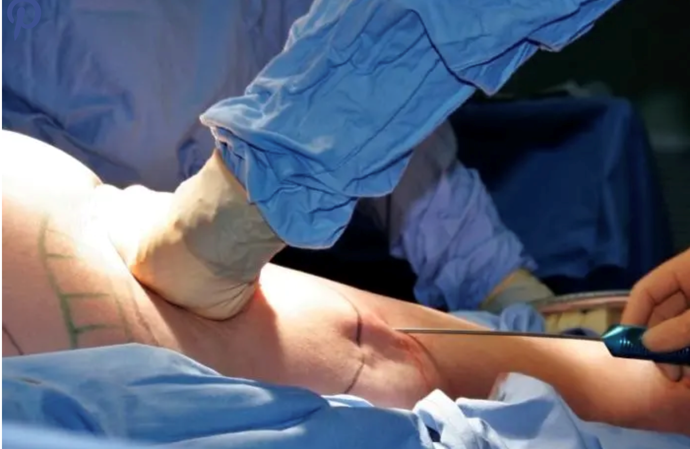 CoolSculpting Scottsdale
