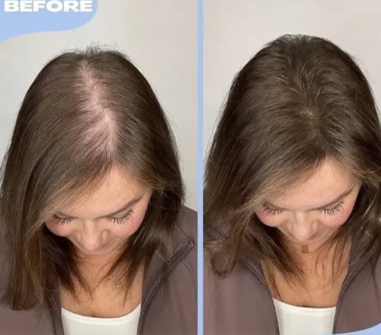 Hair Filler Scottsdale