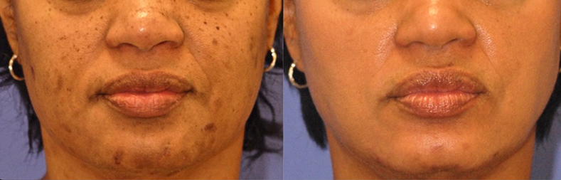 Pigmentation: Hyperpigmentation Scottsdale | Skin Spot and Discoloration Treatments Phoenix