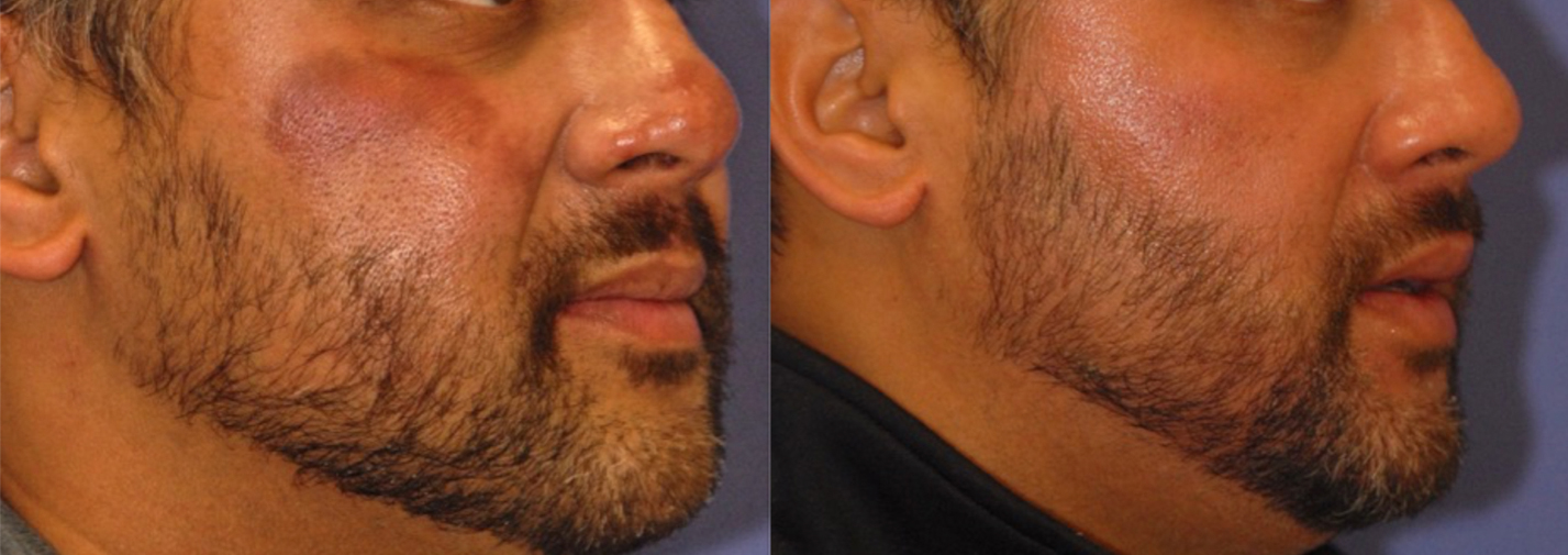 Hyperpigmentation Before and After