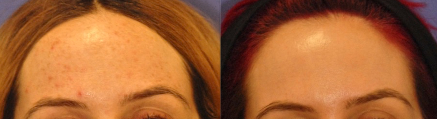 Hyperpigmentation Before and After