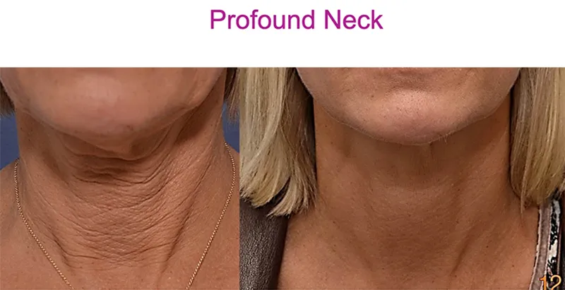 before after profound neck