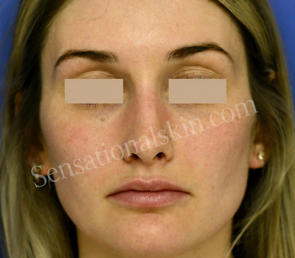 Before Photo Facial patient